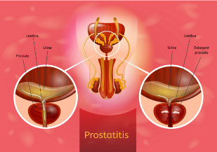 la prostatite