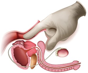 massaggio prostatico