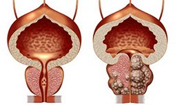 Sano e malsano della prostata