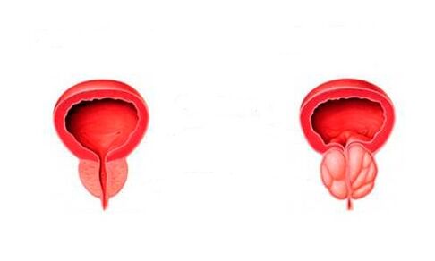 prostata sana e infiammata con prostatite