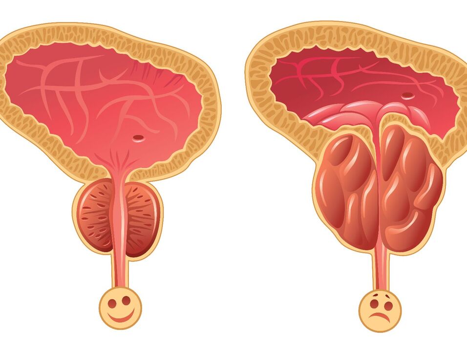 Prostata sana e congestione della prostata con prostatite congestizia