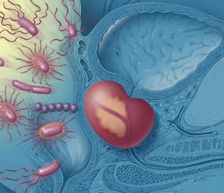 Infiammazione della prostata